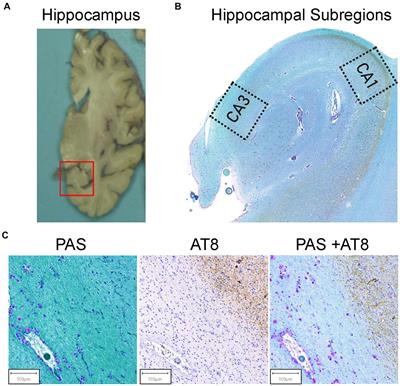 Corpora amylacea negatively correlate with hippocampal tau pathology in Alzheimer’s disease